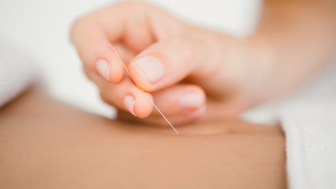 Akupunktur